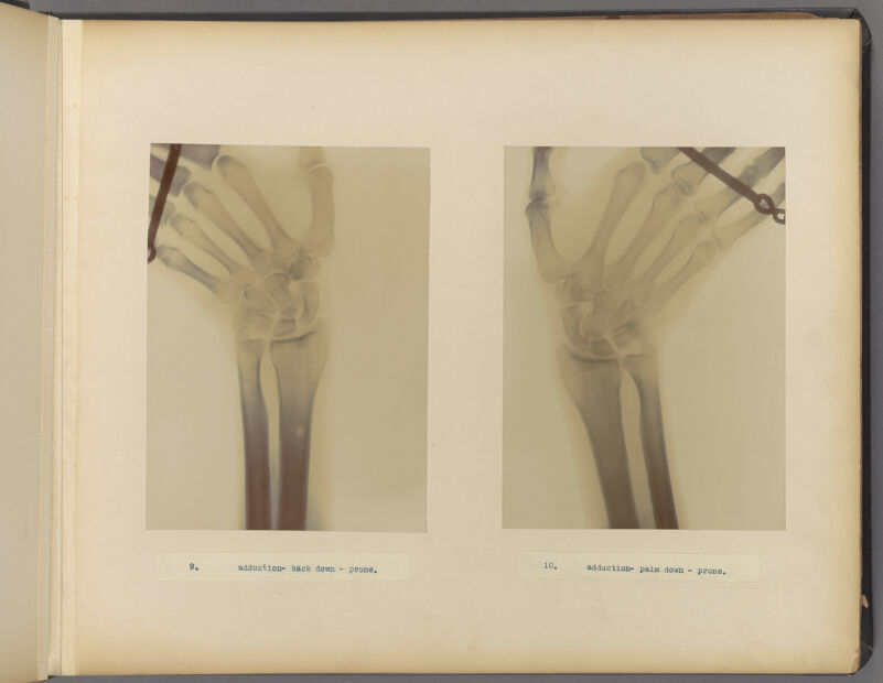 X-rays showing the right and left wrist being bent outwards.