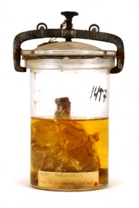 Clavicle with sarcoma in a glass specimen jar half-filled with liquid. 