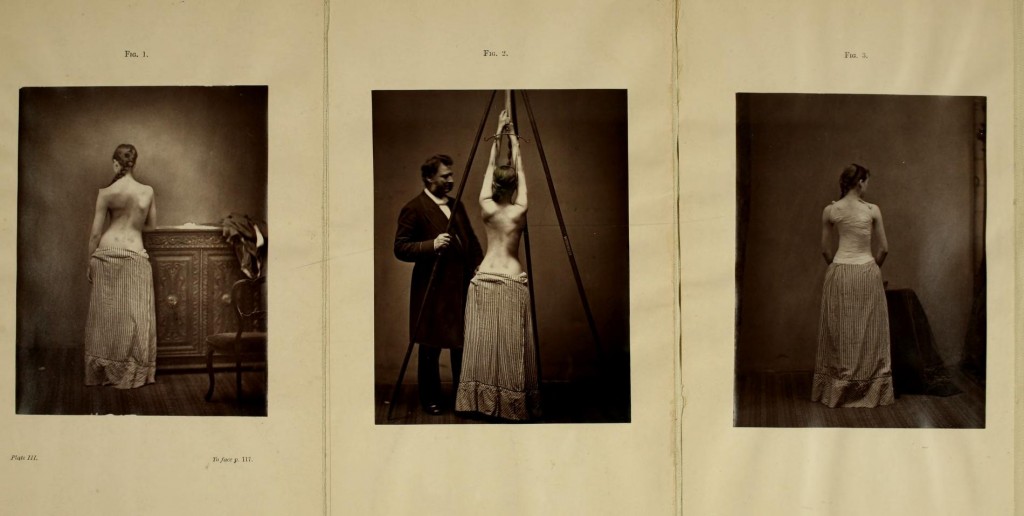 Three photographs. First, a topless woman in a long skirt standing with her back to the camera, displaying a curved spine. Second, Sayre suspending her by the wrists from a tripod. Third, the woman stands with her back to the camera again. Her spine appears to be straighter and she is wearing a bandage around her torso.