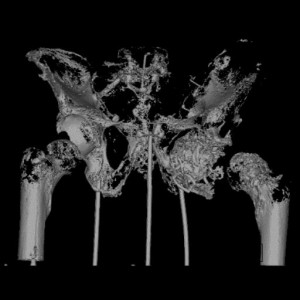 CT scan of Lowell's sacrum, pelvis and femur upper extremities. 