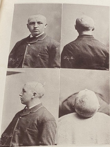 images of man with a skull wound from four angles.