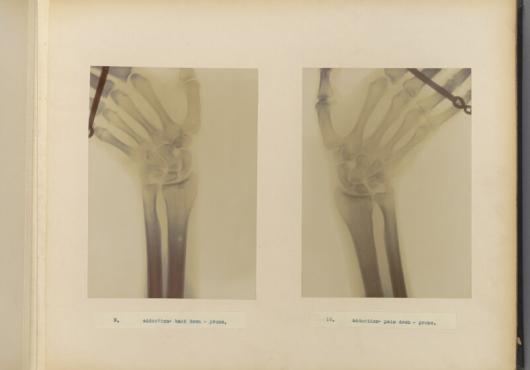 X-rays showing the right and left wrist being bent outwards.