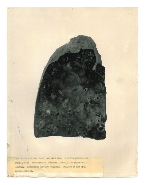 Photograph of a lung tissue sample from 1918 showing flu damage
