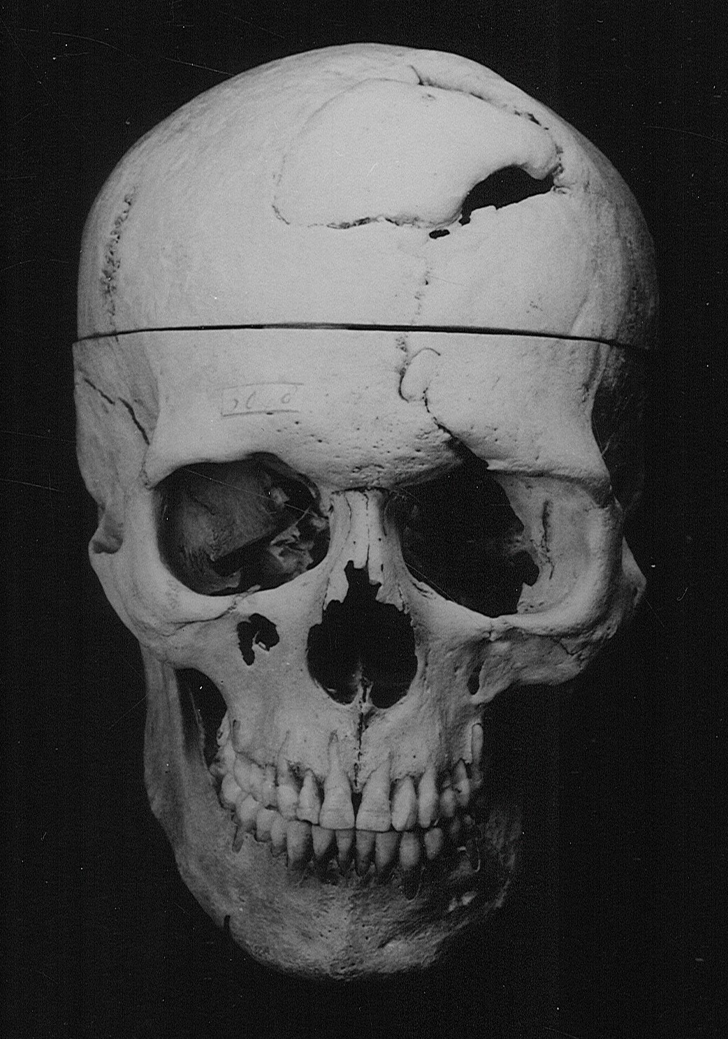 front view of the skull of Phineas Gage